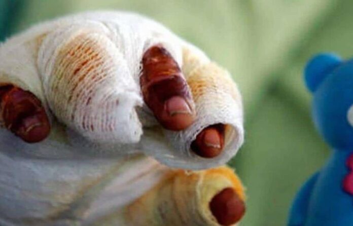quemado