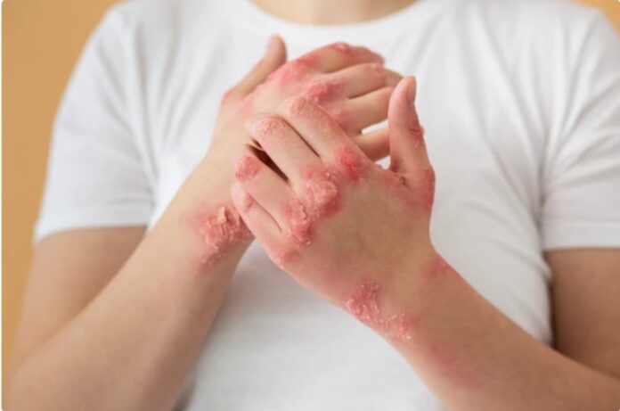 dermatitis