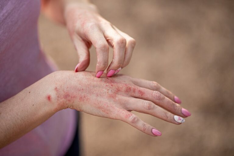 Todo lo que debes saber sobre la dermatitis por calor