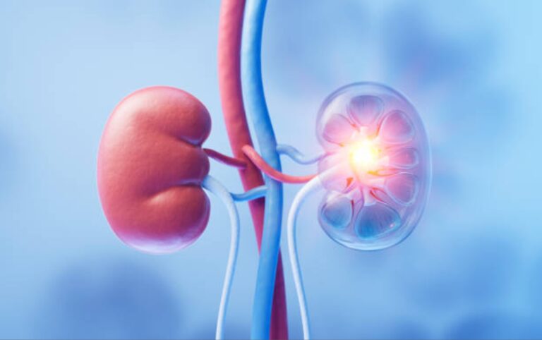 Día Mundial del Cáncer de Riñón: síntomas ocultos que merecen atención médica
