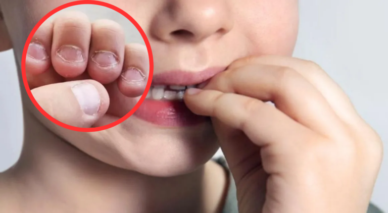 Alerta dental: morderse las uñas puede alterar la mordida