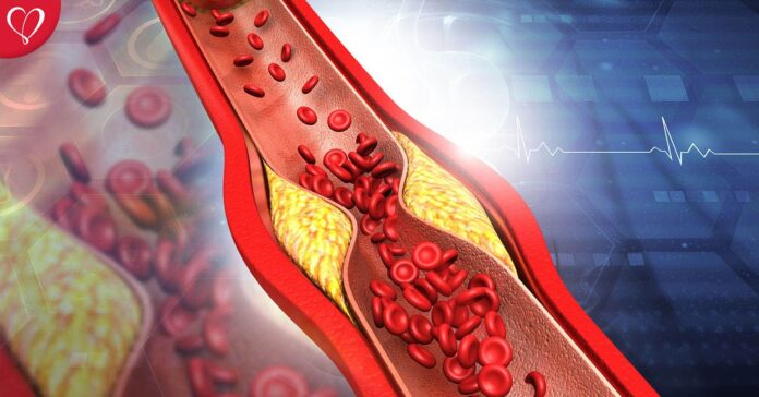 arterial