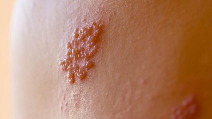herpes